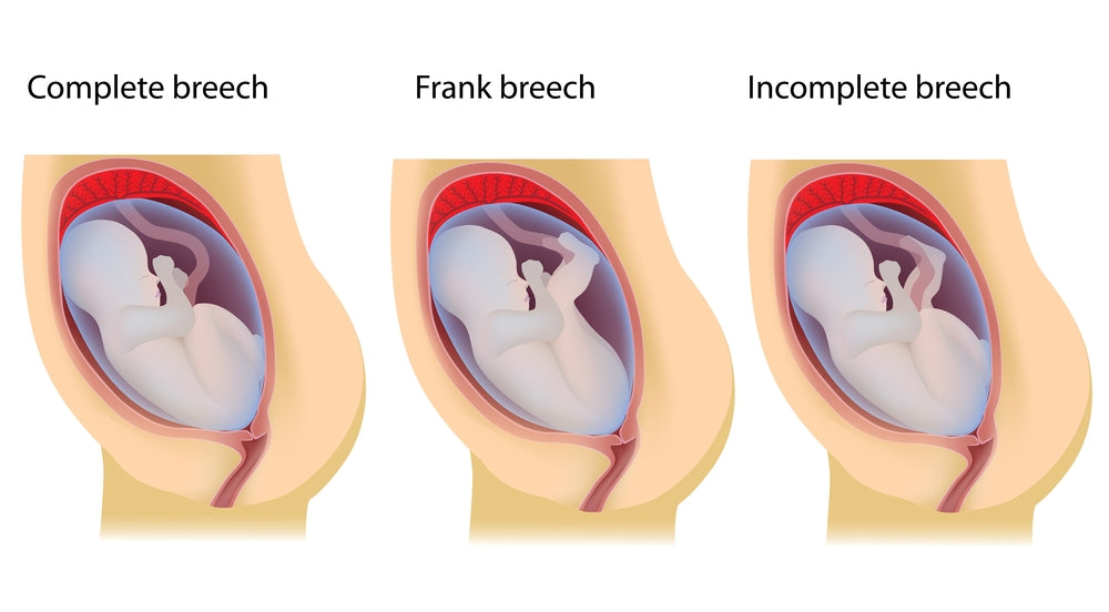 A complete breach, frank breach & incomplete breach | Nourish Baby