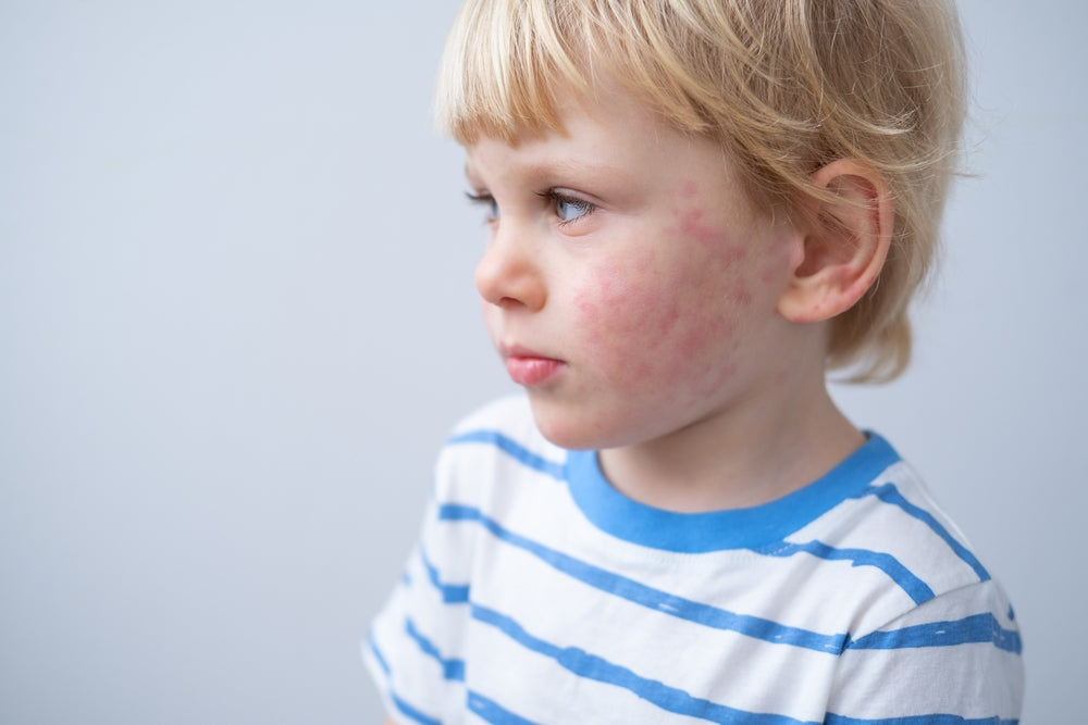 When to worry about a rash on a toddler